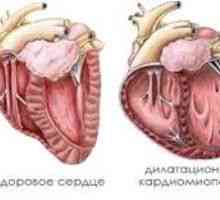 Dilatačná kardiomyopatia, príčiny, príznaky, liečba