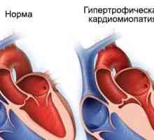 Hypertrofickej kardiomyopatie, príčiny, príznaky, liečba