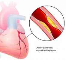 Ischemická choroba srdca
