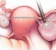 Endometria ovariálne cysty - príčiny, príznaky, liečba
