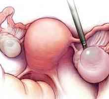 Endometria ovariálne cysty
