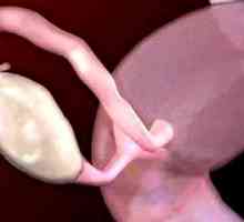 Cysty na vaječníkoch: Príznaky