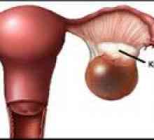 Cystoma (vpravo, vľavo), vaječníkov - príčiny, liečba