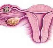 Persistence ovariálne folikul - príčiny, príznaky, liečba