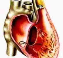 Srdcová astma