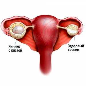 Folikulárny cysta vaječníka