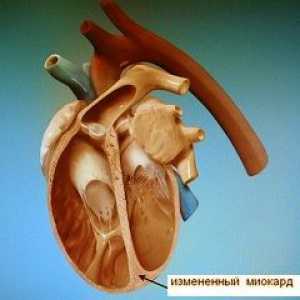 Kardiomyopatia
