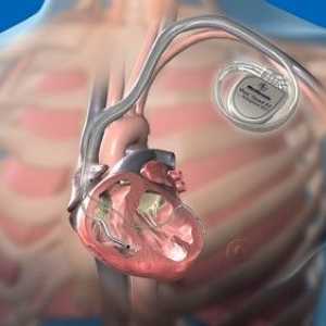 Kardiostimulátor: Aké sú kontraindikácie po inštalácii