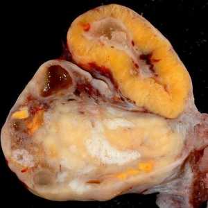 Cysta na vaječníku žlté teliesko: príznaky a liečba
