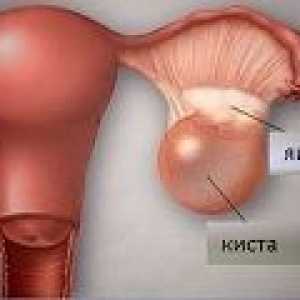 Ruptúra ​​ovariálne cysty - príčiny, príznaky, liečba